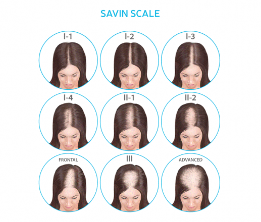 Female Pattern Hair Loss - Lifestyle Pharmacy